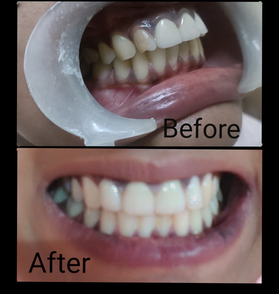 Before & After: Single Front Tooth Restoration