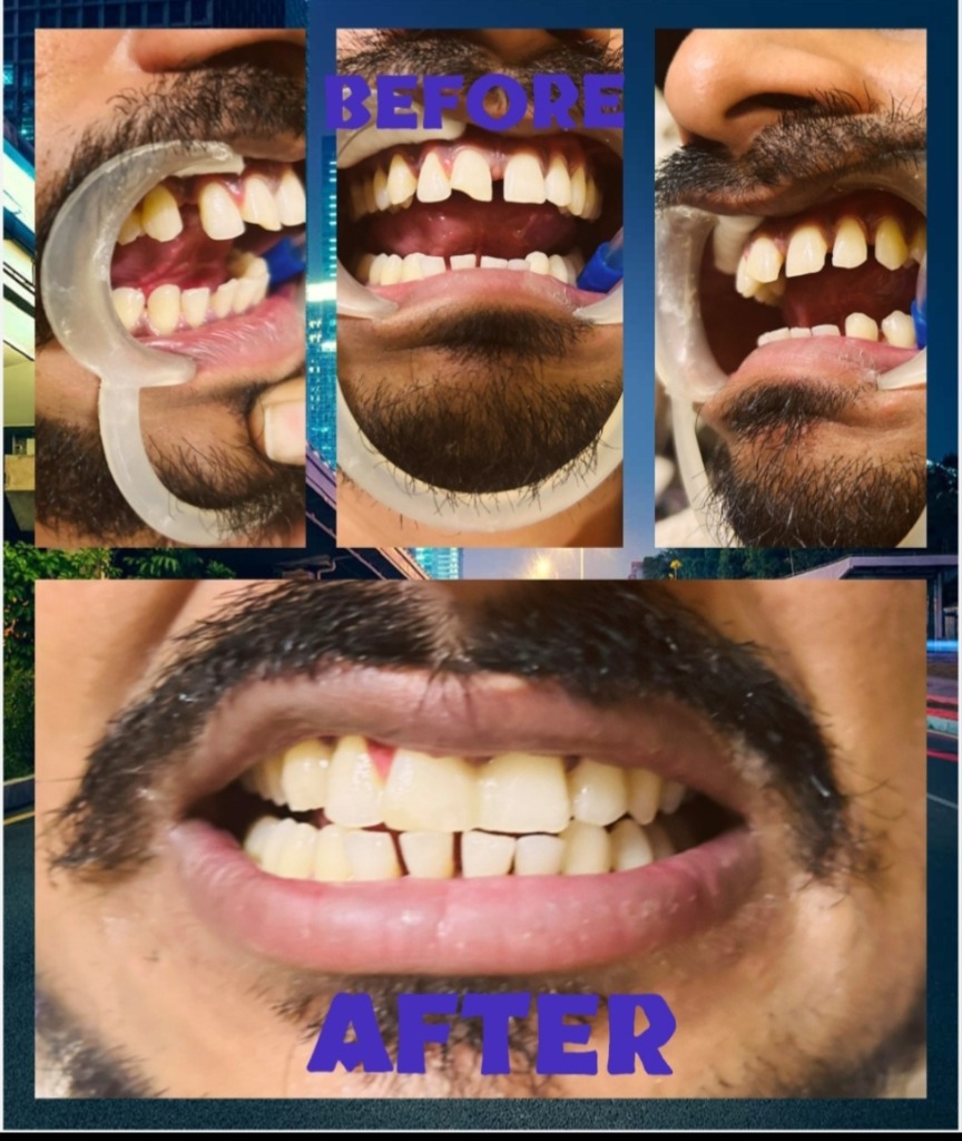 Before & After: Full Cosmetic Smile Design